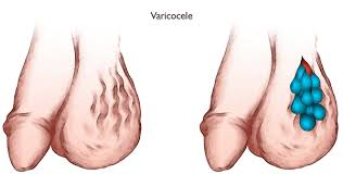 Illustration for article titled Obat Herbal Alami Varikokel